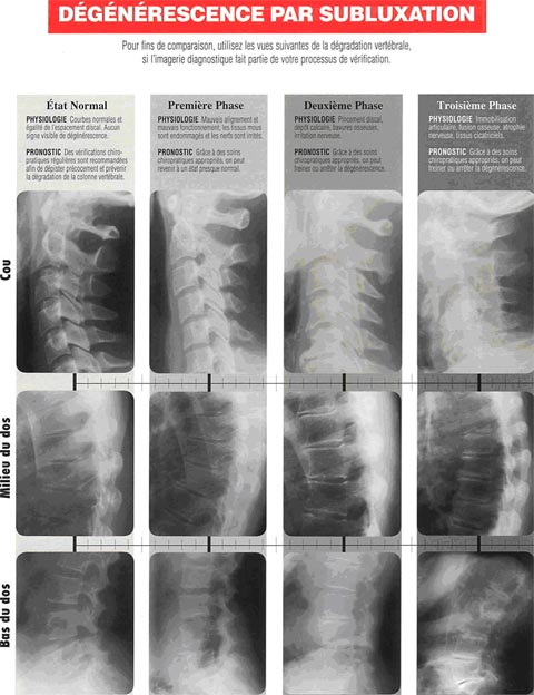 subluxation