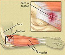 Tendinite