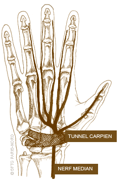 Tunnel carpien